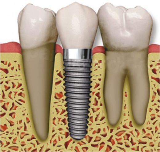 dd_201704241800_dental-implant.jpg
