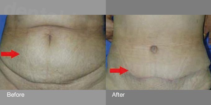 dd_201709210839_tummy-tuck-before-after-photo-2_0.jpg