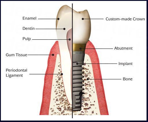 Anatomy of a Dental Implant
