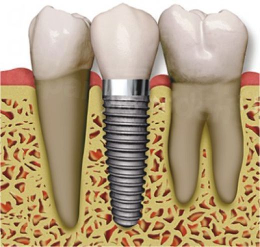 Dental Implants Abroads