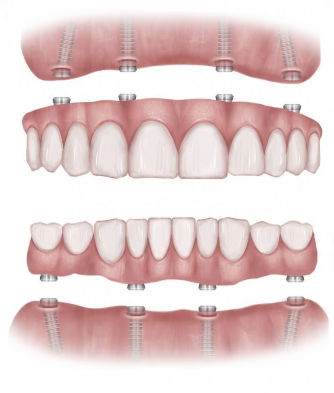 dd_201705032228_all-on-4-dental-implants-kent.jpg
