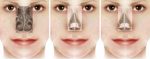 dd_201705042005_septoplasty-diagram-4.jpg