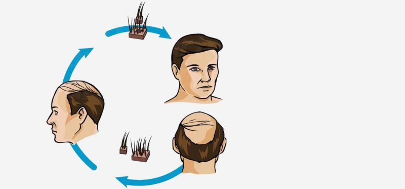 dd_201707052007_top-10-hair-transplant-centers-in-indore.jpg