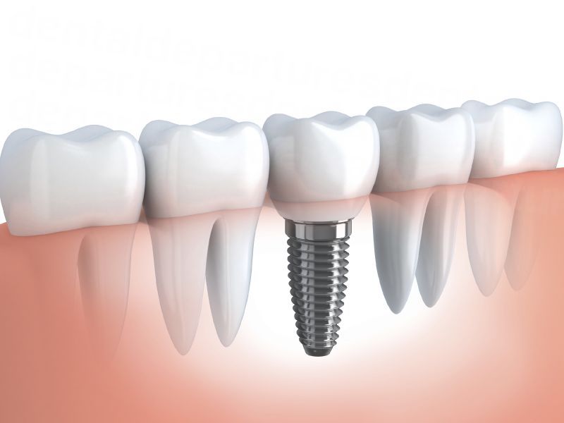 dd_201901080609_dental-implants-1.jpg