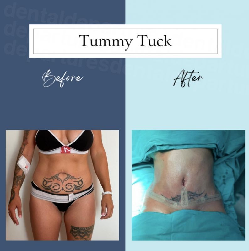 Top 10 Clinics for Tummy Tuck in Turkey - Medical Departures