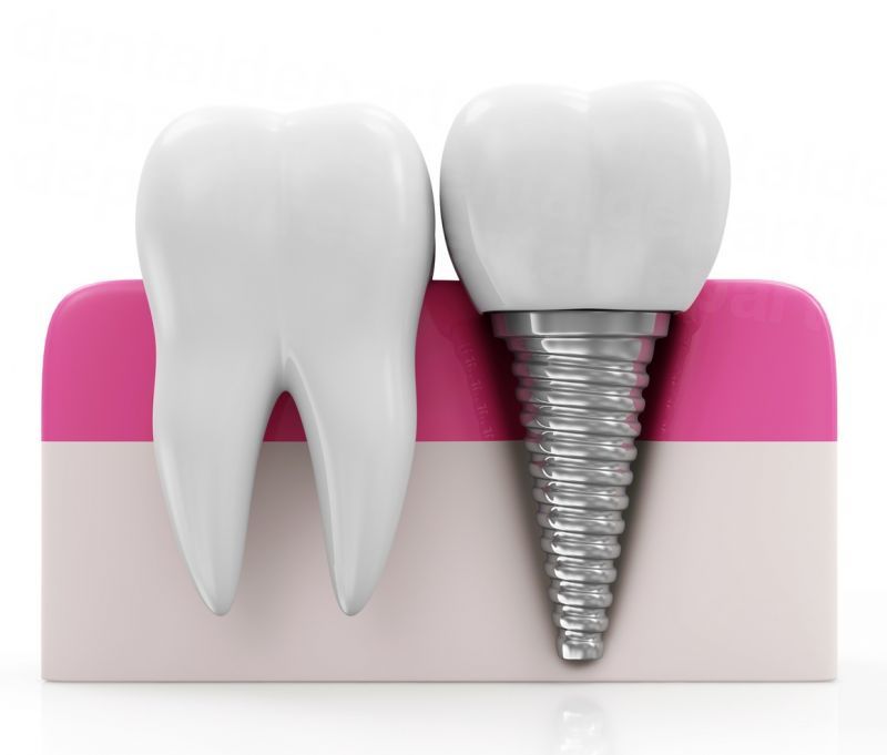 dd_202209071339_dental-implant-abroad.jpg