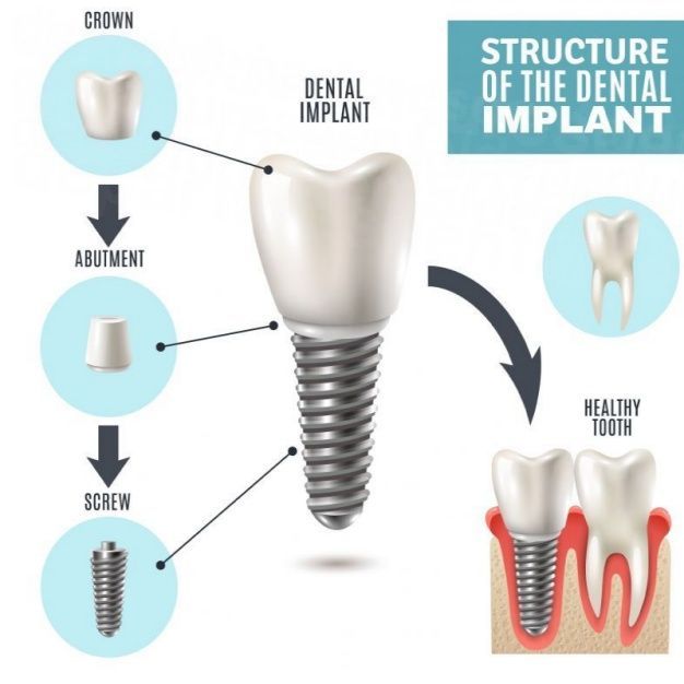 dd_202209080713_dd_202207050723_dental-implant.jpg