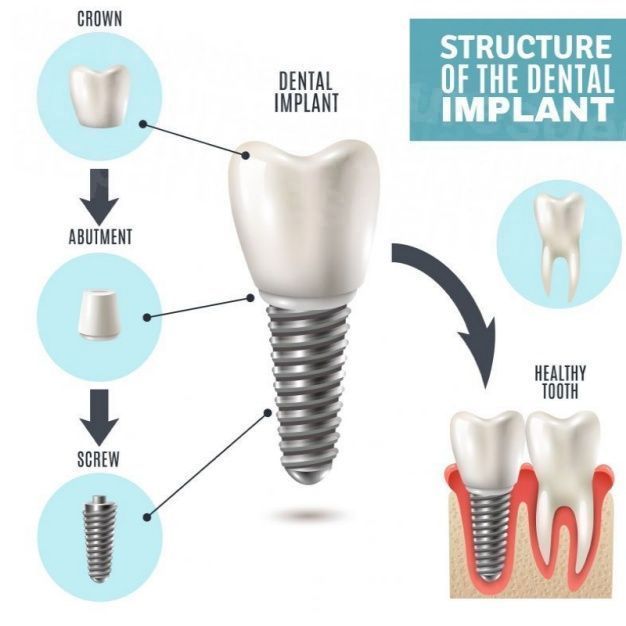 dd_202209090506_dental-implant.jpg