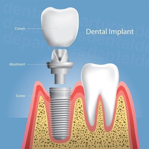 dd_202304270818_dental_implant_resized.jpg