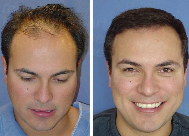 How Much Does Hair Transplant Cost in Thailand?