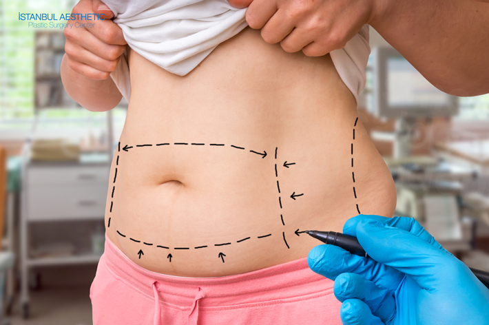 Tummy Tuck Turkey - Clinicpark