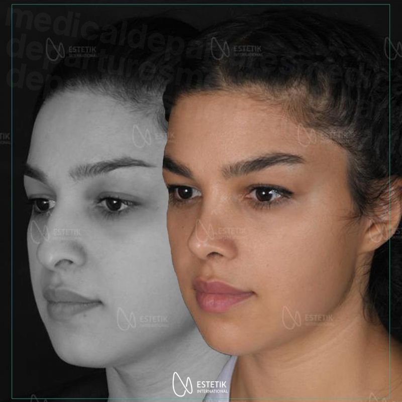 md_202111290715_rhinoplasty_before_and_after_estetik.jpg